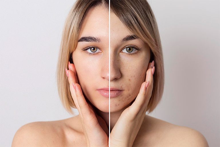 Akne (Acne Vulgaris)