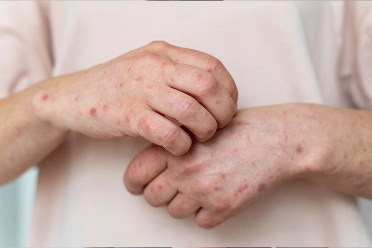 Mantar hastalığı ve biorezonans